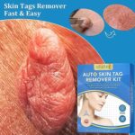 Skin Tag Remover Kit 2 in 1 for Micro to Large (2 mm - 8 mm / 1 Set) - Back View by Nari Haat, Indian ethnic wear, wo...