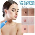 Skin Tag Remover Kit 2 in 1 for Micro to Large (2 mm - 8 mm / 1 Set) - Neckline Detail by Nari Haat, Indian ethnic we...