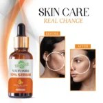 VIGI&GLO Niacinamide 10% Face Serum | Acne Marks, Oil Control & Pore Tightening | Herbal | 30ml - With Dupatt...